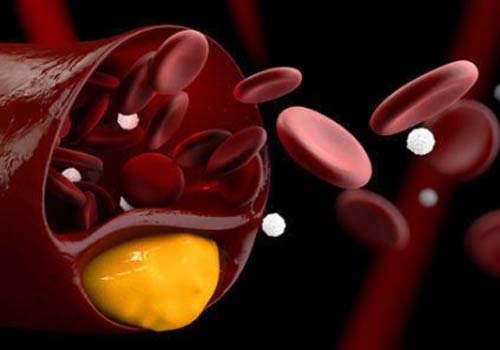 La fluorescence aggrave les maladies cardiovasculaires